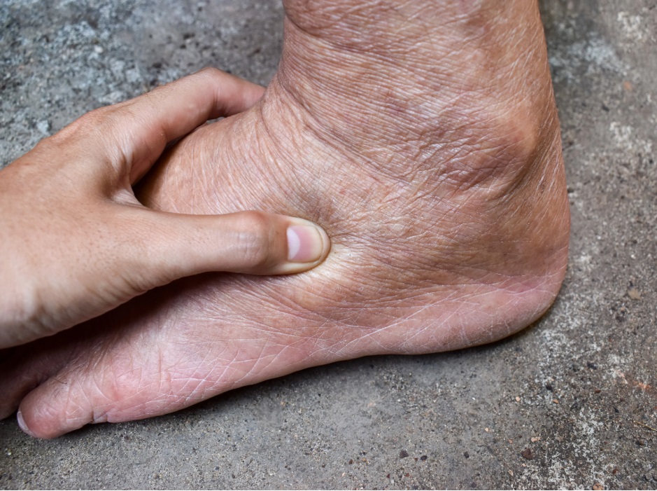Typisches Symptom bei Herzinsuffizienz: Wassereinlagerungen in den Beinen